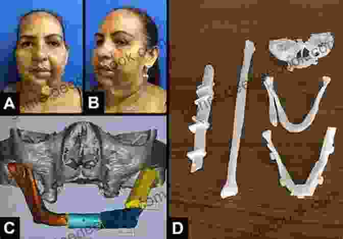 Free Flap Transplantation In Plastic And Reconstructive Surgery Path Breaking Work In Plastic And Reconstructive Microsurgery